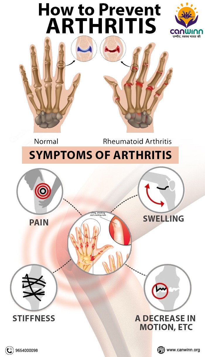 how to orevent arthritis