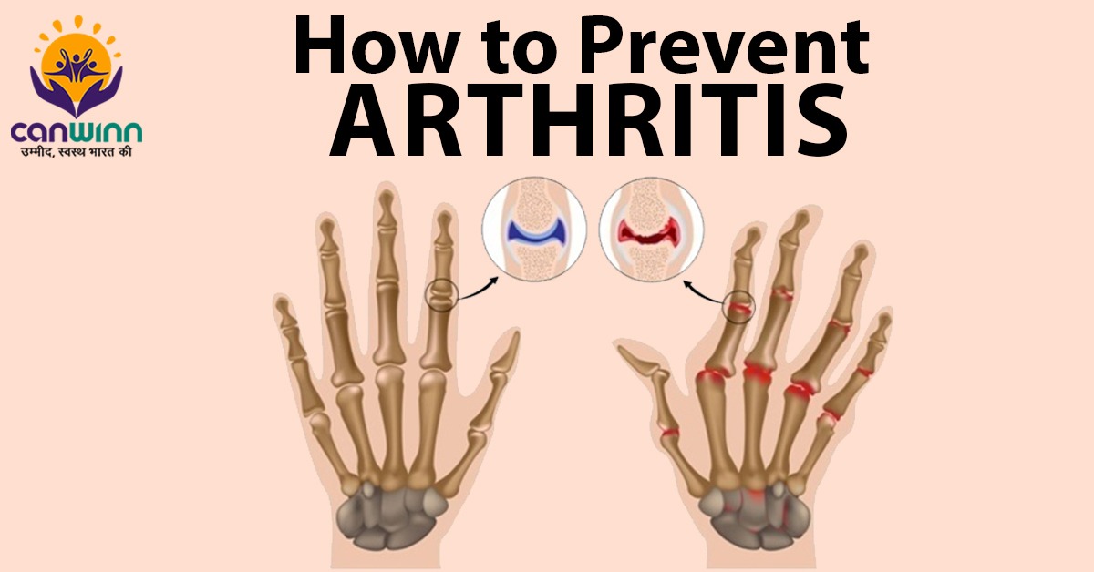 How to Prevent ARTHRITIS