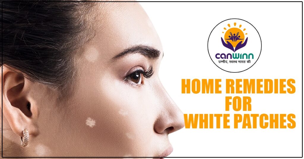 Best Home Remedy For White Patches On Skin