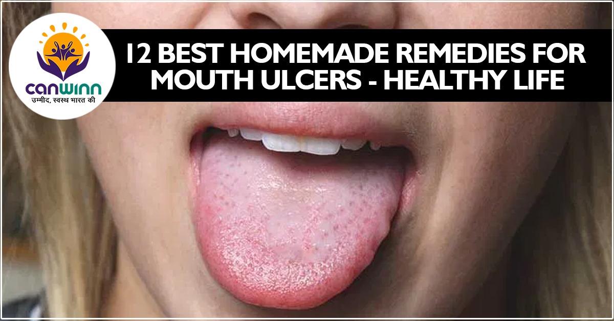 12-best-homemade-remedies-for-mouth-ulcers-healthy-life-canwinn