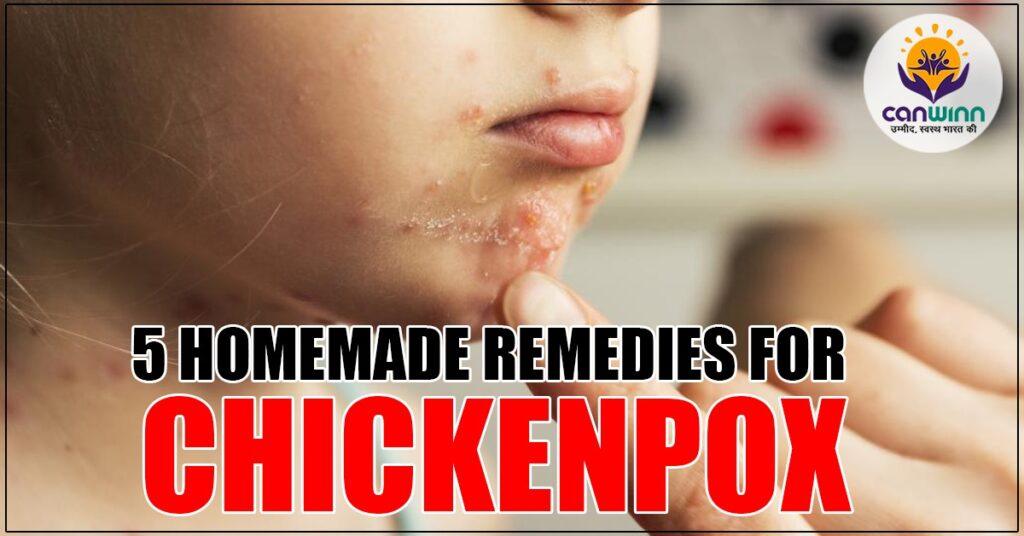 5 homemade remedies for chickenpox- Canwinn Foundation - Canwinn