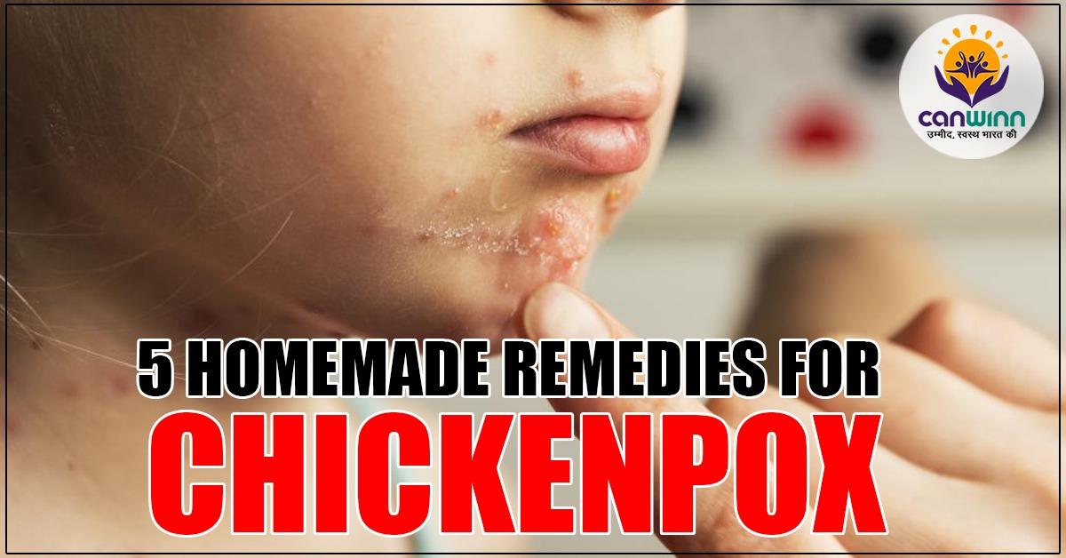 homemaderemediesforchickenpox CanwinnFoundation