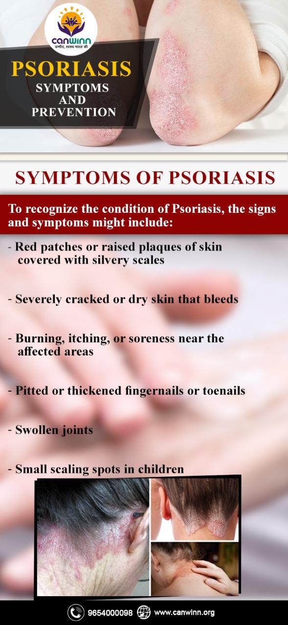 Psoriasis symptoms and preventions