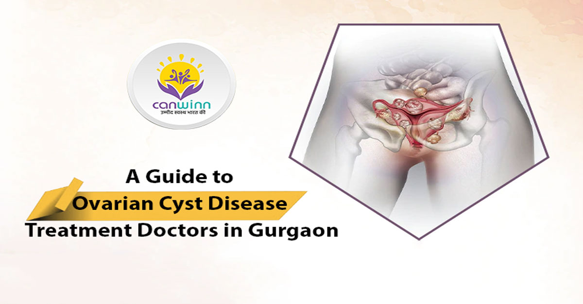 A Guide to Ovarian Cyst Disease Treatment Doctors in Gurgaon