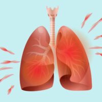 Asthma Disease Chronic lung Disease