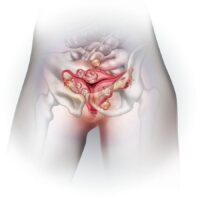 Ovarian Cysts Disease