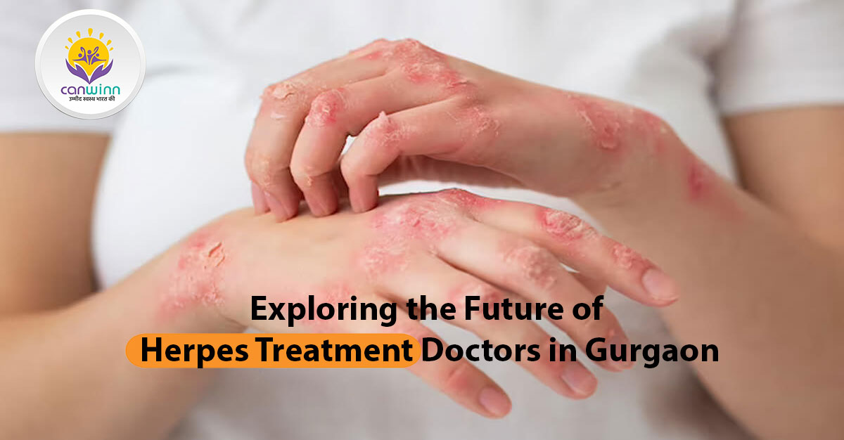 Exploring the Future of Herpes Treatment Doctors in Gurgaon