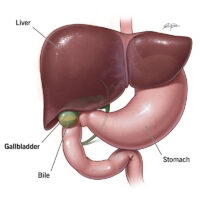 Gall Bladder Stone Disease Treatment